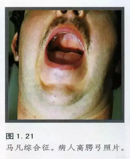 马凡氏综合征天才体型后面的隐患