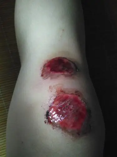 骑车摔伤,一直在留水,需要去医院吗?