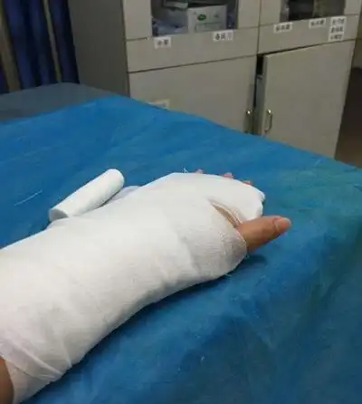手骨折图片 (15)_有来医生