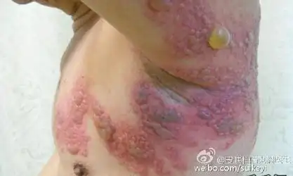 【转载】蛇缠腰解毒膏------一包灵