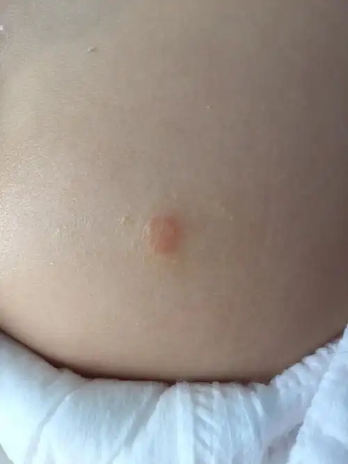 我儿子屁股上长包之前咨询过您两周过去了抹了肤乐霜和艾洛松