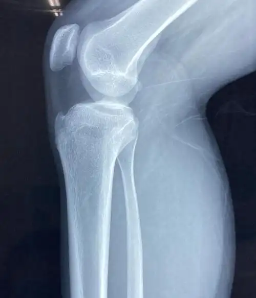 胫骨结节骨软骨炎_软骨炎_发病原因_症状表现_治疗方式 - 好大夫在线