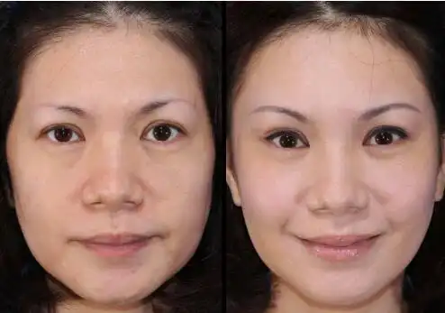 北京高兰德光子嫩肤对比图