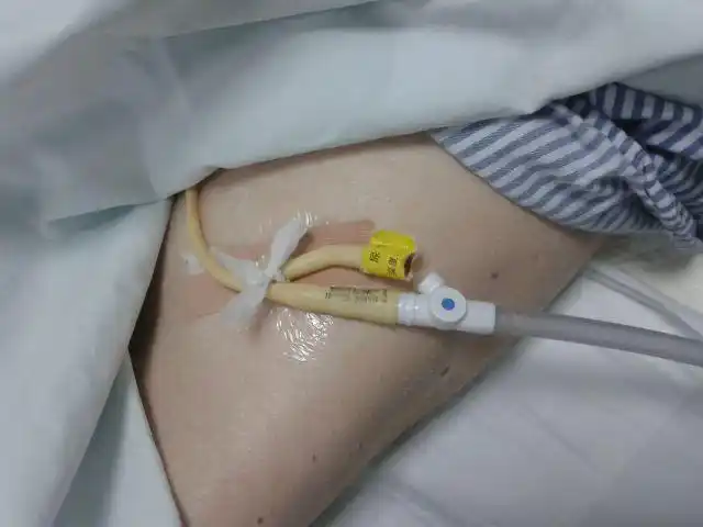 妇科手术导尿管护理