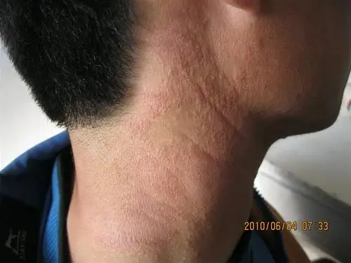 6.4刚接的病人 神经性皮炎 申请 分