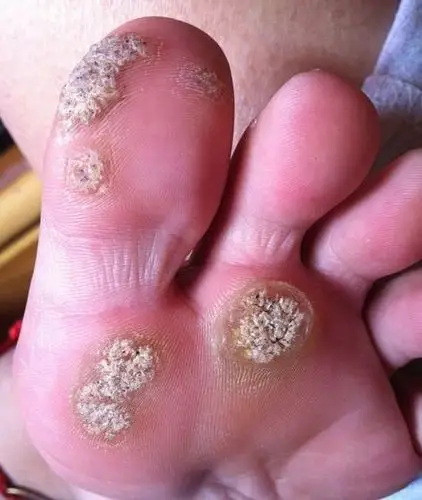 跖疣?还是胼胝?答案全在这了!