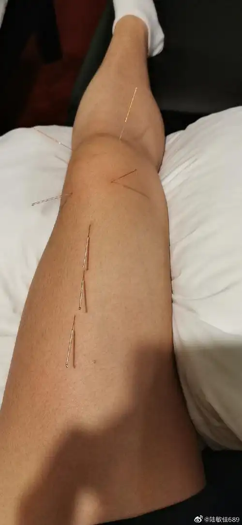 原创心疼谢震业女友针灸治膝关节伤扎7根今年跳远6米38无缘世锦赛