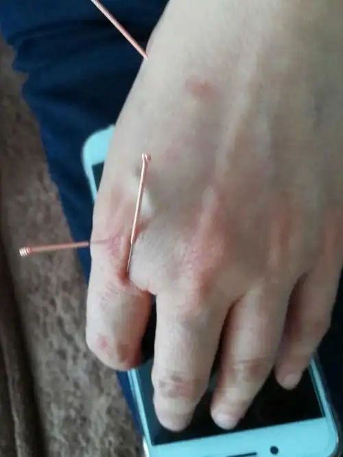 肩周炎,针灸奇效,秒杀疼痛!