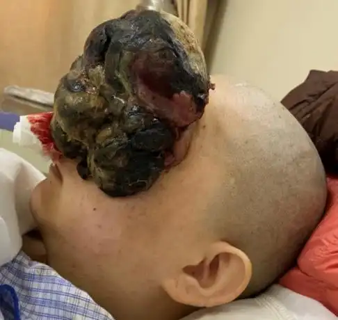 颅底恶性肿瘤切除游离瓣修复1例