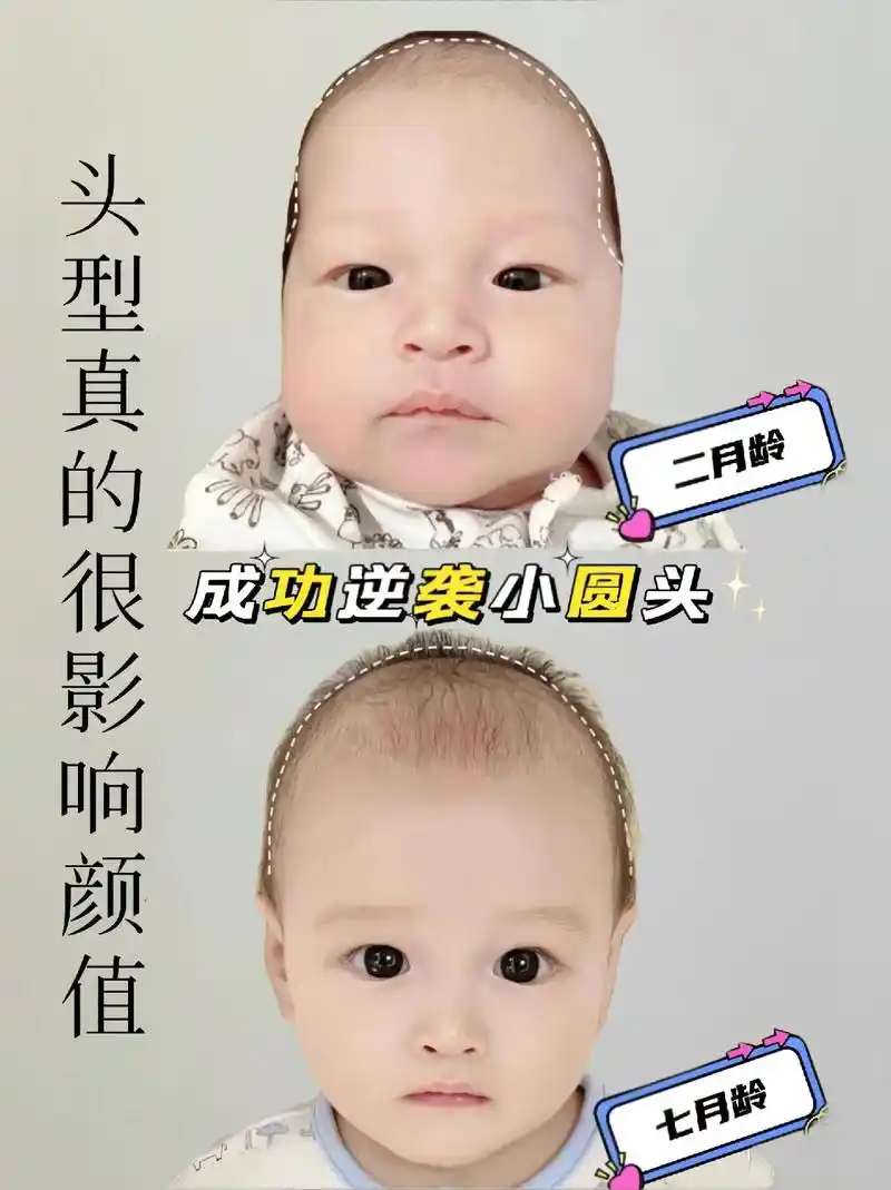 宝宝总喜欢歪头睡,慢慢容易偏头扁头斜颈.前6个月是宝宝睡头型 - 抖音
