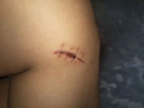 军检膝盖部位有疤痕合格吗