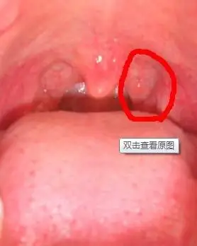 吃甜得东西的时候,现在拍了张照片,好像是悬雍垂旁边又多了一个小疙瘩