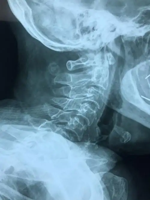 下颈椎关节突骨折脱位 - 好大夫在线