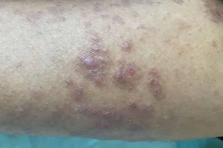 神经性皮炎图片