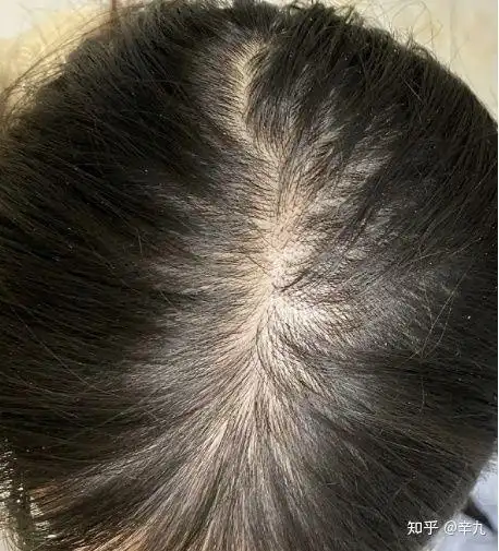 女生头顶头发少是什么体验 ?