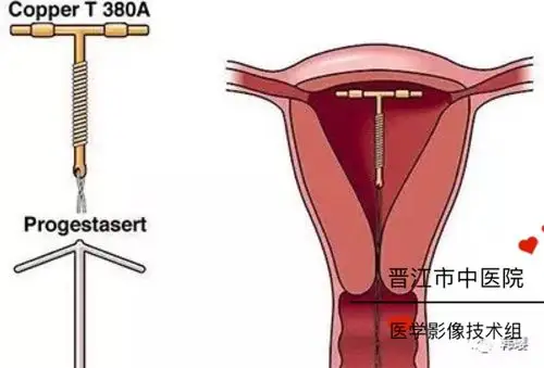 晋江市中医院影像技术科普:体内金属植入物能否行磁共振检查?