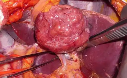 14种常见肝脏良恶性肿瘤图解