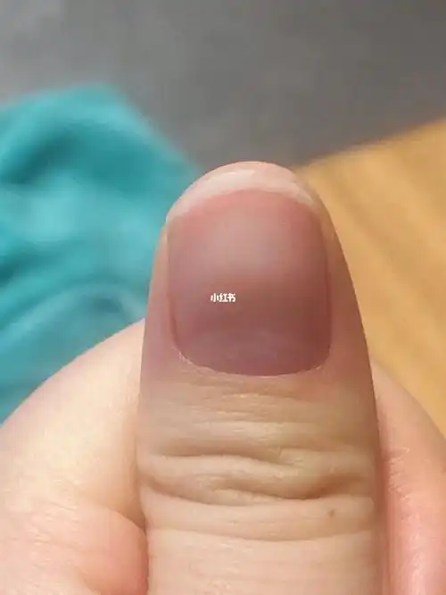 大拇指甲突然凹陷