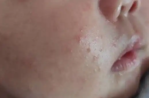 新生儿常见皮疹