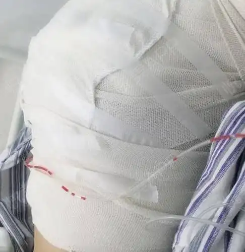 术后第一天,还在床上躺着呢,做的假体,纱布包成这样.隆胸_悦美整形