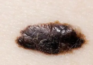 28岁姑娘点了颗痣,竟发生癌变……痣出现这4种特征癌变可能性大_方法