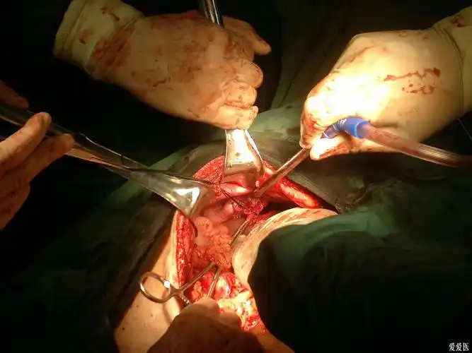 **分享**我手术时的图片