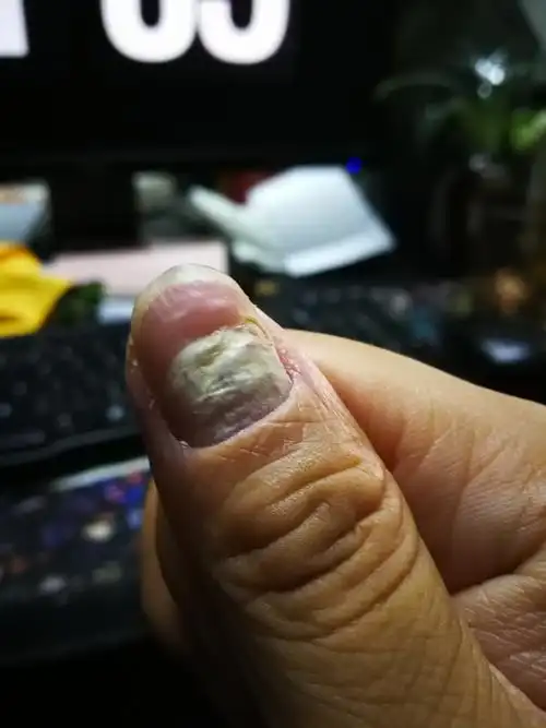 大拇指指甲不知道怎么了,求解