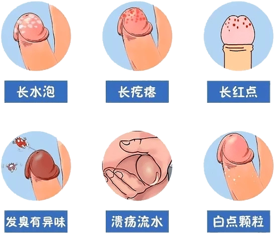 宁波天一泌尿专家男科指南:大暑将至,做好4点,远离龟头炎_男性_包皮