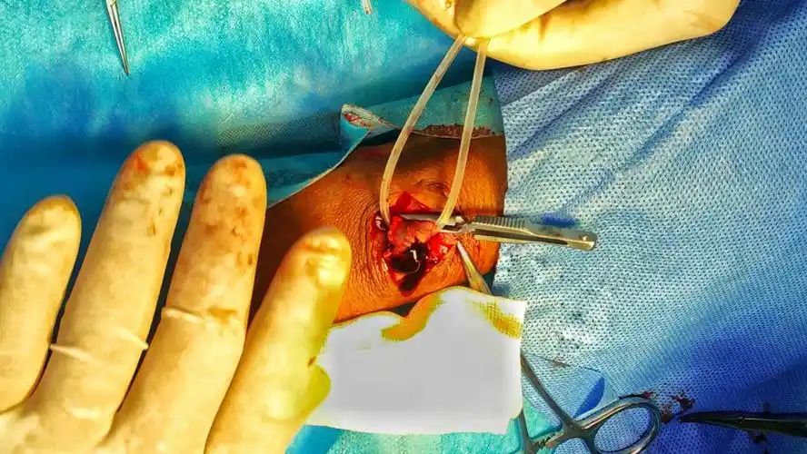 强调一点:导尿管操作前,向头静脉管腔内注入适量利多卡因,减轻操作时