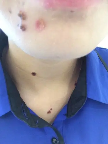 点痣之后第三天那个疤我抠掉了,好大好深一个洞,怎么样才能不留疤