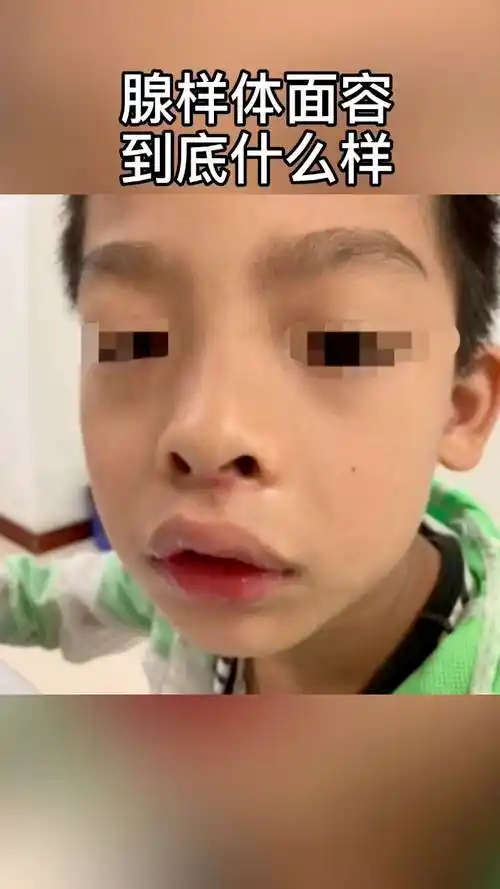 为什么孩子会得腺样体肥大