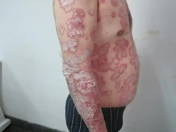 牛皮癣症状图片牛皮癣会影响生育吗?