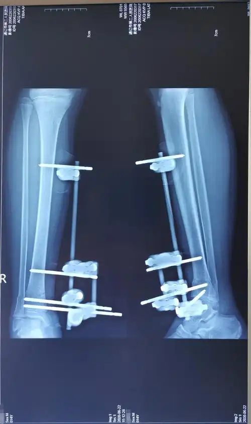 14岁胫腓骨远端骨折闭合复位外固定架固定手术一例