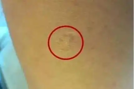 胳膊上从小就有的那个疤,原来是这样来的