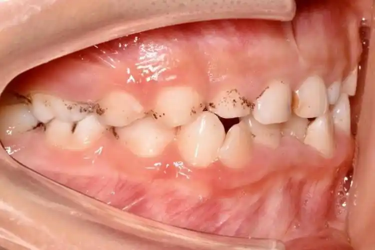 宝宝牙齿有黑渍图片,儿童牙齿发黑图片_大山谷图库