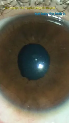 外伤性瞳孔散大,一个月过去了,还是一点变化没有,帮我看下我这严重吗