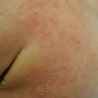 出生几天的宝宝脸上长白色的小痘痘怎麼办?