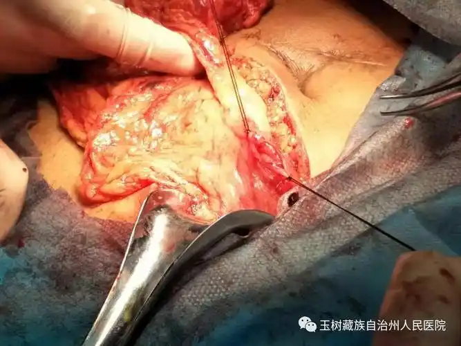 玉树州人民医院外一科成功救治一名严重腹部外伤患者