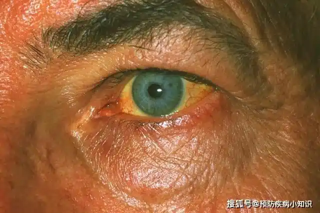 36岁男子肩膀疼却被查出肝癌!肝癌早期的5个信号,你一定要知道