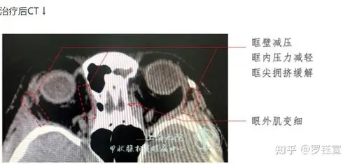 图 2  减压手术前眼部ct图 1  眶减压手术ps:如下图,内壁指内眼角方向