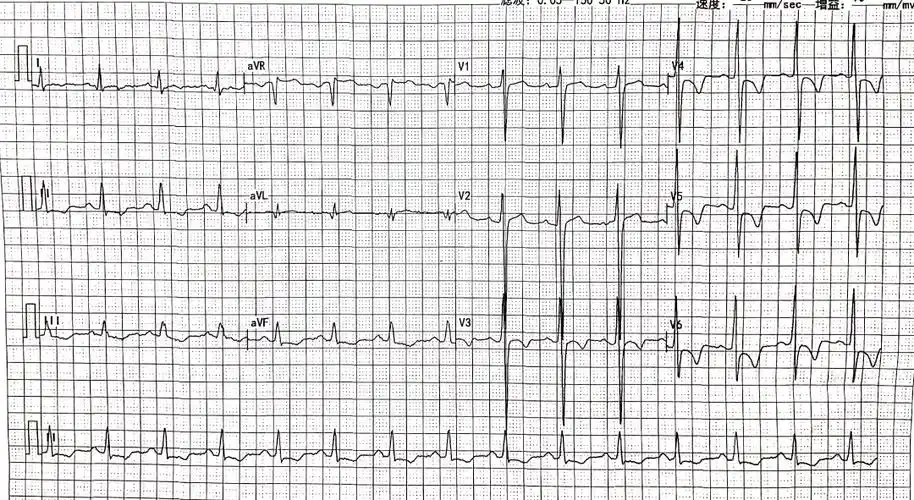 st-t改变,第一印象就是心肌缺血,那么这种心肌缺血表现的心电图就一定