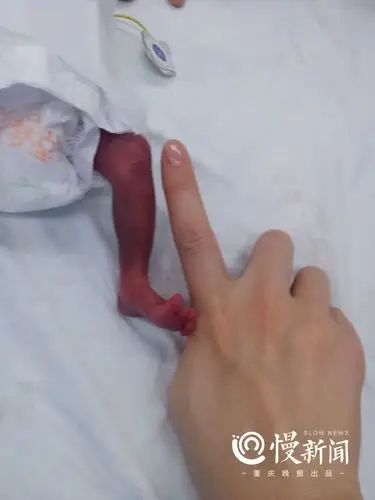 奇迹!重庆580克袖珍婴儿怀孕24周降生,开启三个月"闯关求活"模式