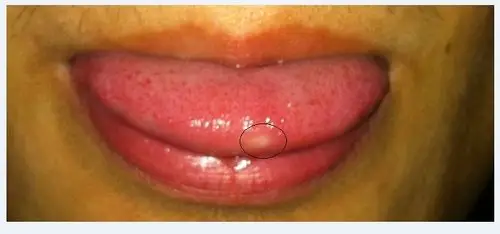 舌头长了颗白色的东西很疼怎么办?