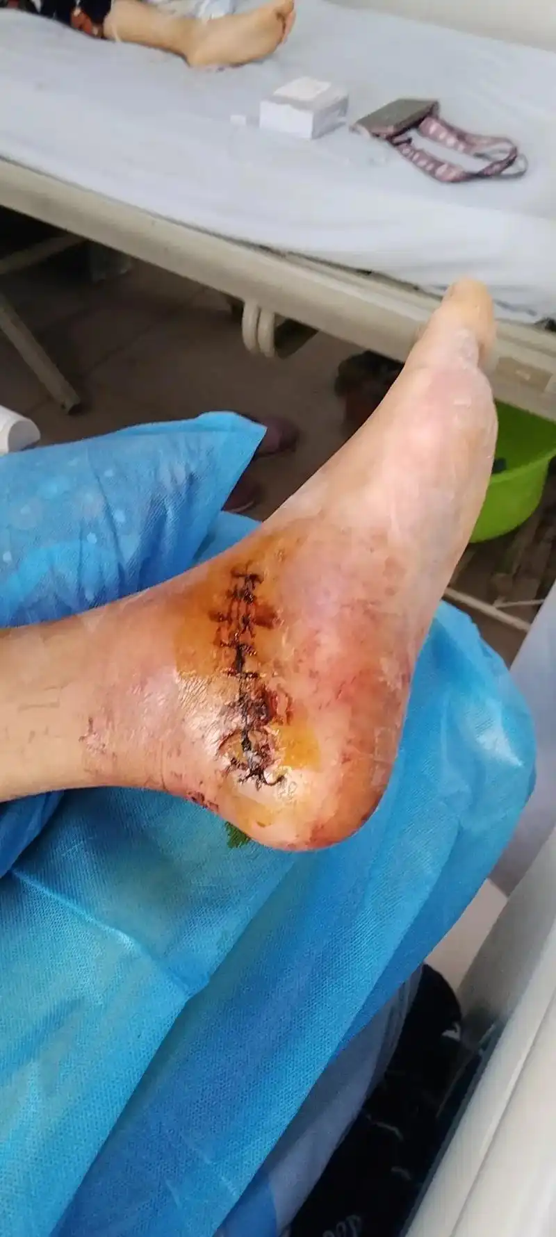 今天是意外发生的265天,第二次手术后的35天,伤口终于闭合 - 抖音