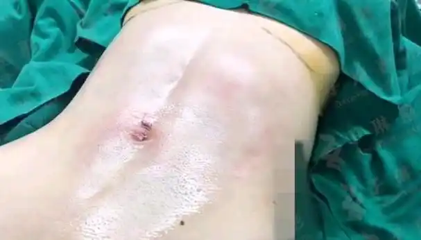 腹部脂肪抽除,就是利用专用的抽脂枪对腹部进行负压抽吸.