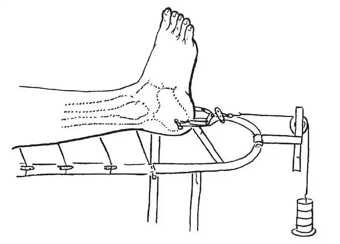 8 跟骨牵引术-骨科手术-医学
