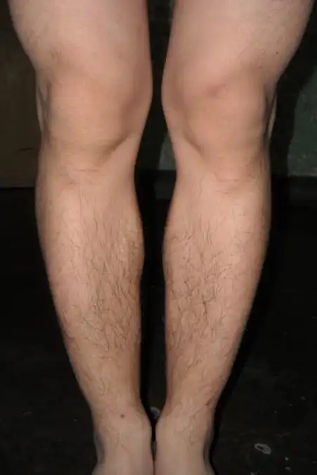 请问一下,这是什么腿型,x有点,o又有点.