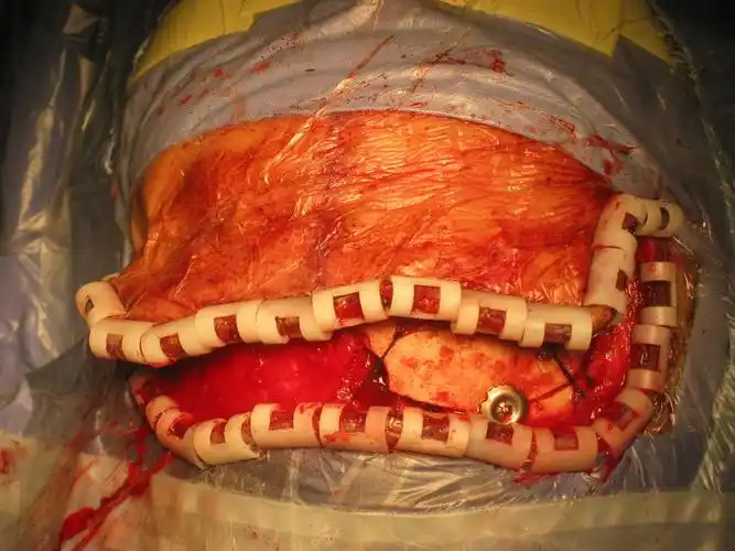 开颅手术不可怕_脑肿瘤_脑肿瘤手术 - 好大夫在线