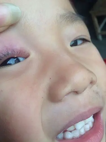 宝宝长针眼帮忙看一下有什么妙招