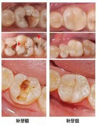 北京的儿童医院补牙一般多少钱这个附带医院介绍的价格表属实不错